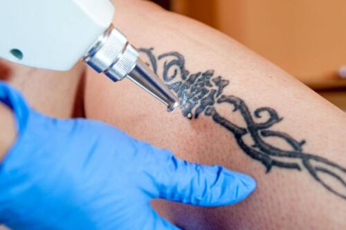 Tattoo-Removal-Image